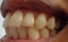 side bite