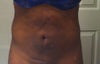 20 days Post Front (Lumping & hardness)