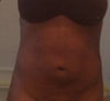 My abs at 7 day post, before lumping & hardness occurred.
