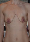 pre op