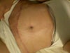5 weeks post op