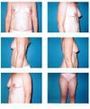 Deflated Breasts - currently wear 34B bra - but more like a B-, A+ cup and "stovepipe" thighs