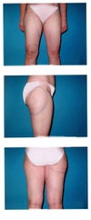Unshaped butt, love handles