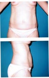 Post two c-sections belly pouch