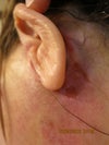 Open sores