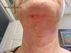Droopy Saliva Gland