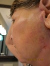 Sores and Bruising