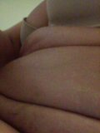 Stomach after smart lipo