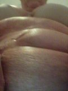 Stomach after smart lipo