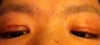 the incision seems deeper and tighter.. causing the eyelashes to sprout up causing asymmetry