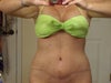 MY ABDOMEN IS FINE WHEN I STAND STRAIGHT BUT WHEN I BEND OVER IT IS STILL LOOSE AND SAGGY