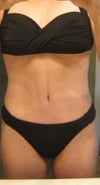 2 months postop