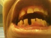 lower right jaw
