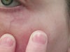 Veins under left eye.