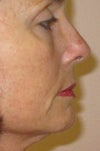 Full right side of face shows fat pad and loose neck 1-12
