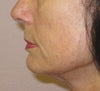 Shows left side of face w fat pad and lose neck