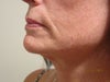 What is best long term solution?  Left side after six Matrix and skin tightening no noticable change;  may have helped build collegen;  two microcurrent tx; Fat pads unchanged, microcurrent might help tighten neck if done regularly,  but medical esthetician said would probably need regularly tx for that to last