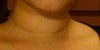Post-ulthera