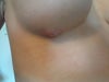 The blister that began to form on the scar line