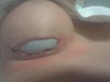 A 2cm extrusion occurred. This was 2 wks after PS attempted to sew it back in. As you can see it reopened significantly further. The stitches used appeared to be a running stitch which the skin was not strong enough to hold. my implants have now been removed.