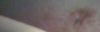 Scar under right eye