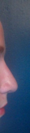 The bridge of my nose looks nice, but my tip is not raised.