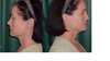 2010 Left & R view after having silicon 1000 in my lips which was unnoticable for years