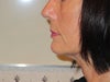 5-12 - Still puffy after 5 matrix and skin tightening treatments and loose neck still there