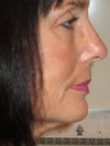5-13 Right side puffy too,  lower FL, MACS do they include neck or will some type of lipo/cut under neck solve?