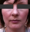 Right nostril is pushed up. But I am fine with the bridge.