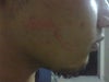 this was the scar left after that surgery 12 years ago...i just hope there is a way to treat this :(