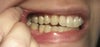 Back molars touch while canines don't.