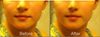 The before is my nose now (LEFT SIDE), and the after is what I want it to look like (RIGHT SIDE)