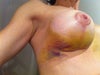 Day 6 post subpectoral 325cc - bruising, tender & full but not bigger than other breast with no bruising.