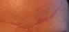 Long. red, indented scar at 7 weeks.