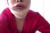 four days after surgery when my face was swollen.