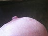 just above nipple, implant is pressing against skin... changing the shape.