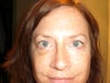 7/15/2012  bruising showing.