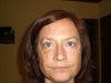 7/18/2012  Bruising yellowing and there is a dark reddish circle bruise about an inch under eye on cheek.  Will this go away in time?