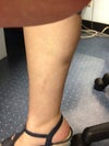 Right calve