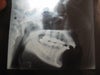 this am my X-ray biting back teethes.