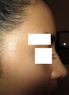 Would the nasolabial angle of my nose change? I like how it currently is