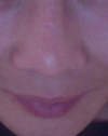 My nose on 05/10/12- before surgery