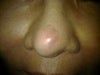 titling to the right, nose tip is rounder and more blunt with redness. some stuff like white bump is shown and hard. Right above the redness, two dents noticeable (4 weeks)