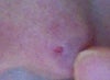 Two weeks after surgery, on July 5th, I found out some tiny bloody liquid was oozing while cleaning up the pores and addressed immediately this issue along with other concerns including shape (roundness) and redness to my surgeon, he said just wait. I speculated that he was telling me that time will solve all the problems.