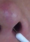 Two weeks after surgery, I also addressed the white string inside of my nose hole that I found while cleaning up inside nose. He told me don't touch it because it will be absolved by itself. After that, all I have heard from him is silence to my several emails.