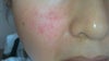 cheek is in reddish and itchy