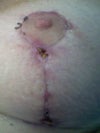 Left - 3.5 weeks post