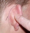 Incision Spot