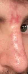 This is a week later while treating with nitropaste. It's a month later and the redness is still there, it seems to be getting a little better though but it's very gradual. At this rate I'm guessing it will take beyond a year before I'm back to normal but I don't know due to the fact that the filler is still in there. Will I have to wait for the filler to dissolve? How can I just have treated this with nitro? Won't the blockage reoccur after nitro discontinuation? How does that work exactly? Can this type of thing be treated with only nitropaste and no dissolve? I can't get a straight answer from my surgeon and I need to answers to relieve my stress. Not only has the cosmetic aspect of this kept me stressed but the thought of the occlusion damaging my skin's structure and underlying collagen has been on my mind. I just need some answers...